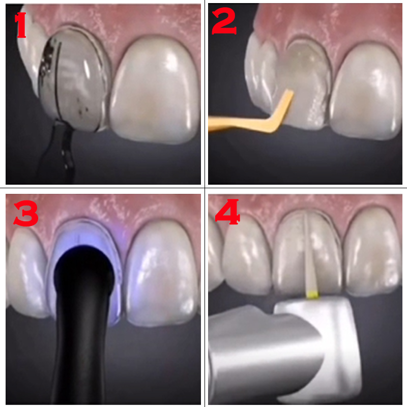 32Pcs Teeth Whitening Mould De - Teeth Whitening Moulds 评论和价格